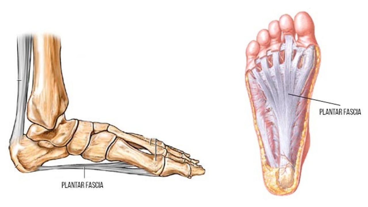 Fascite Plantar