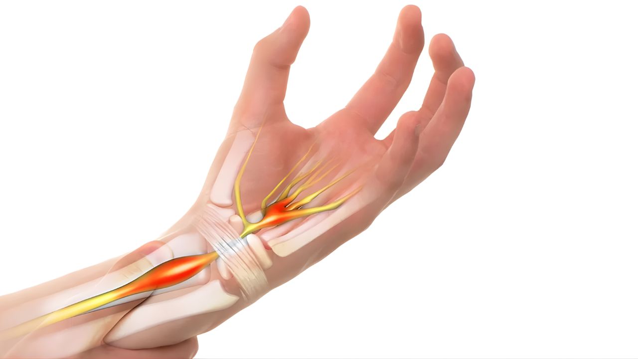 Síndrome do Túnel do Carpo
